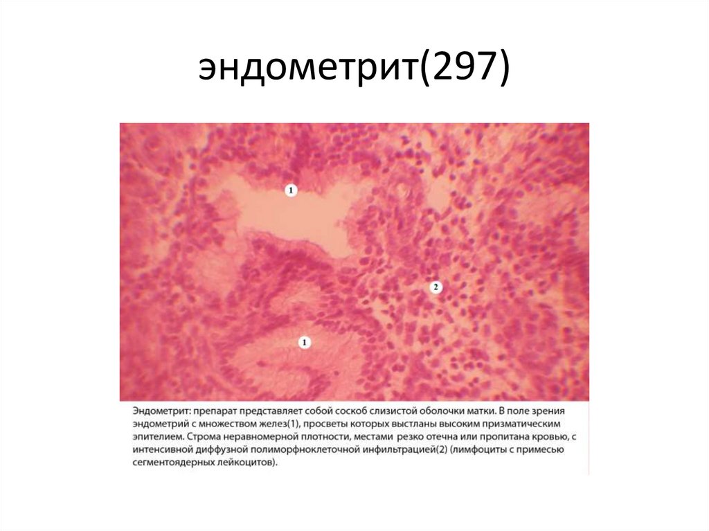 эндометрит(297)