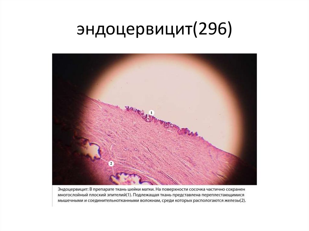 эндоцервицит(296)