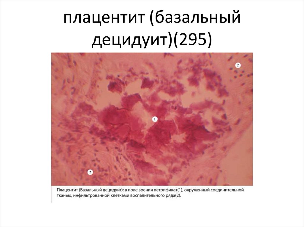 плацентит (базальный децидуит)(295)