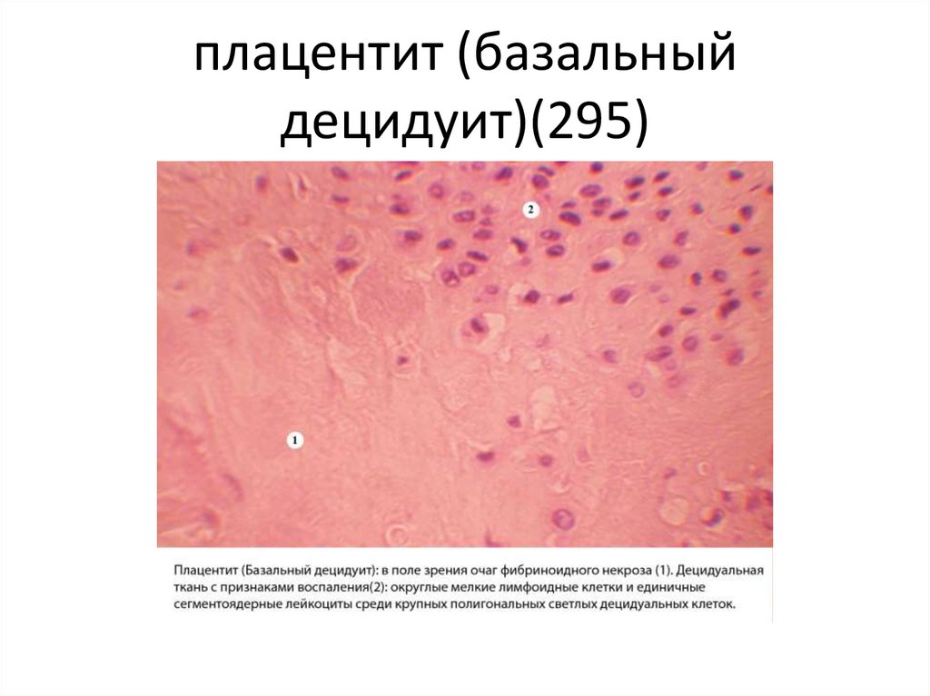 плацентит (базальный децидуит)(295)