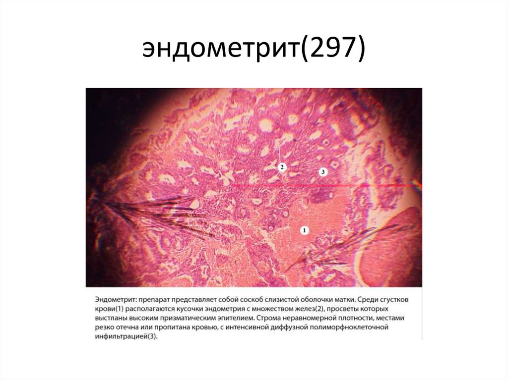 эндометрит(297)
