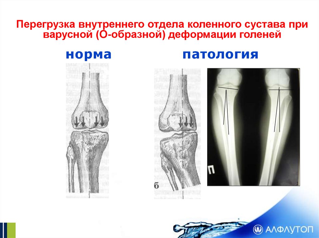 Гонартроз стандарты