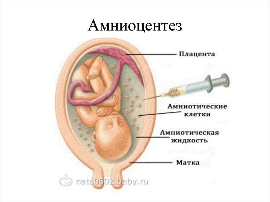 Анализ околоплодных вод. Амниоцентез при беременности. Абдоминальный амниоцентез.