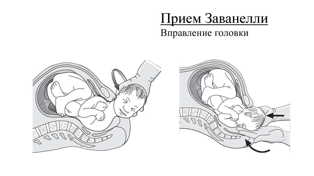 Узкий таз при беременности фото