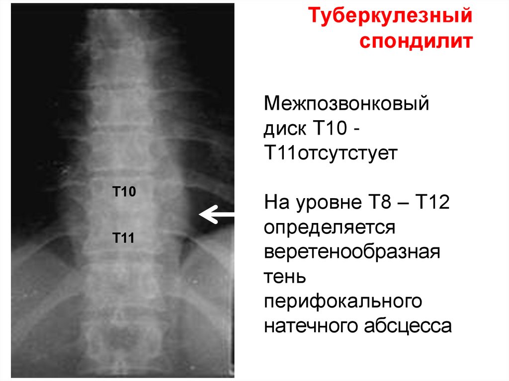 Симптом вожжей. Туберкулез позвоночника 2 стадия рентген. Туберкулезный спондилит позвоночника рентген. Туберкулез позвонков рентген. Туберкулёз позвоночника рентген признаки.