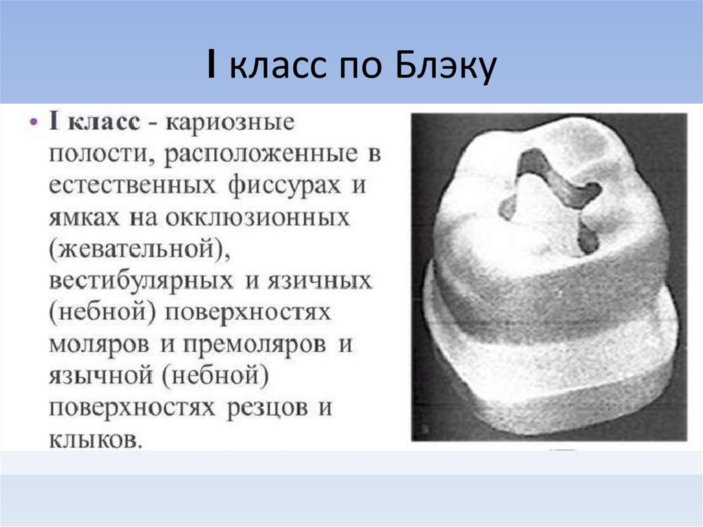 Виды полостей. Классификация кариозных полостей по Блэку. Этапы препарирования 1 класса по Блэку. Первый класс по Блэку препарирование полостей. Кариозная полость 1 класса по Блэку.