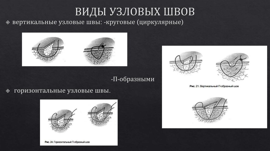 Швы в хирургии презентация