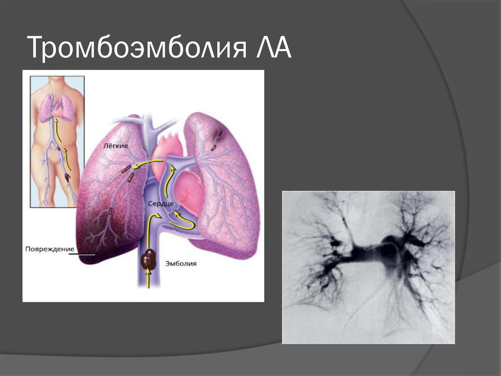 Тромболизис при тромбоэмболии легочной. Тромбоэмболия легочной артерии (Тэла). Эмболия тромбоэмболия. Тромболизис легочной артерии. Тромбоэмболия легочной артерии симптомы.