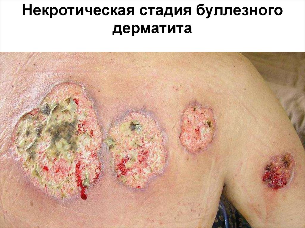 Некротическая стадия буллезного дерматита