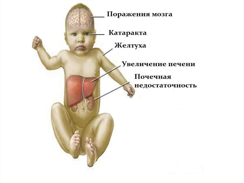 Галактоземия признаки заболевания. Галактоземия генное заболевание. Галактоземия клинические симптомы. Характерная особенность болезни- галактоземия. Клиника галактоземии у новорожденных.