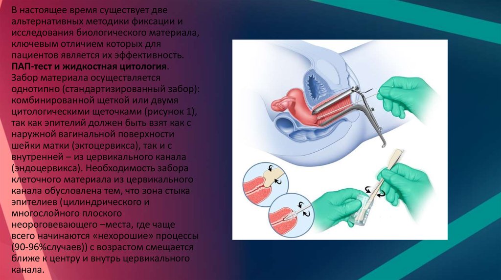 Взятие материала. Пап тест жидкостная цитология. Взятие материала на цитологию. Забор биологического материала осуществляется. Цитология забор материала.