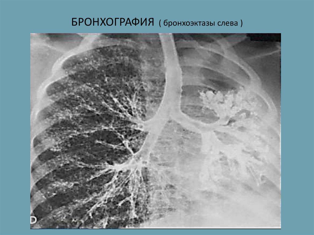 Рентген картина бронхоэктазов