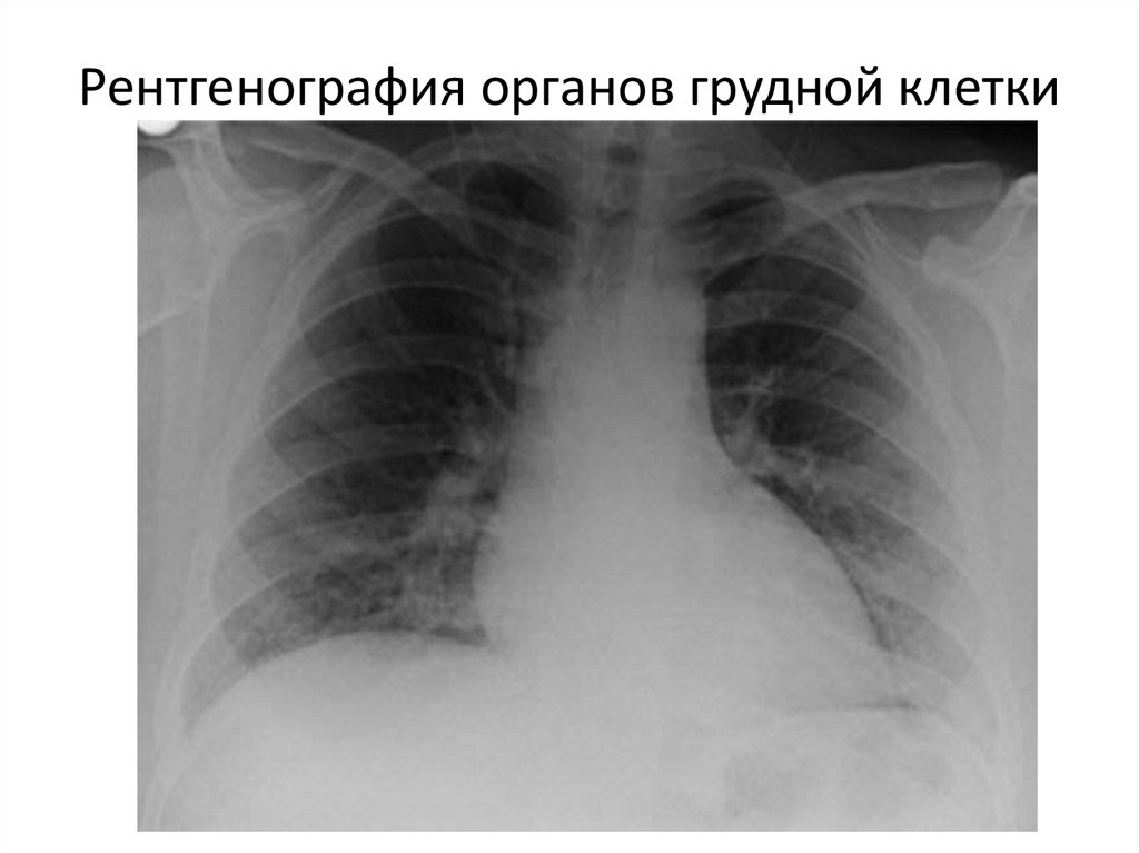 Рентгенография грудной клетки. Рентген органов грудной клетки 2 проекции. Рентгенография органов грудной клетки. Рентгенограмма ОГК. Рентгенограмма органов грудной клетки.