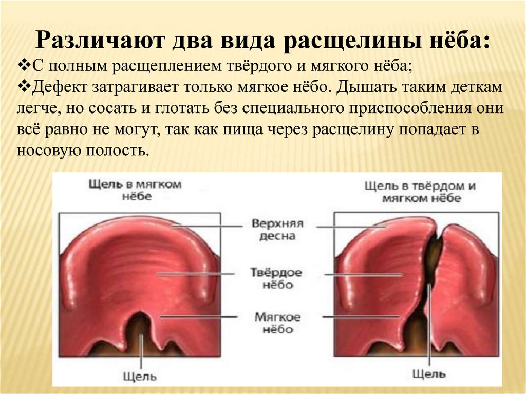 Твердое и мягкое небо. Расщелина твердого и мягкого неба. Субмукозная расщелина мягкого неба. Изолированная расщелина мягкого неба. Расщепление мягкого и твердого неба.