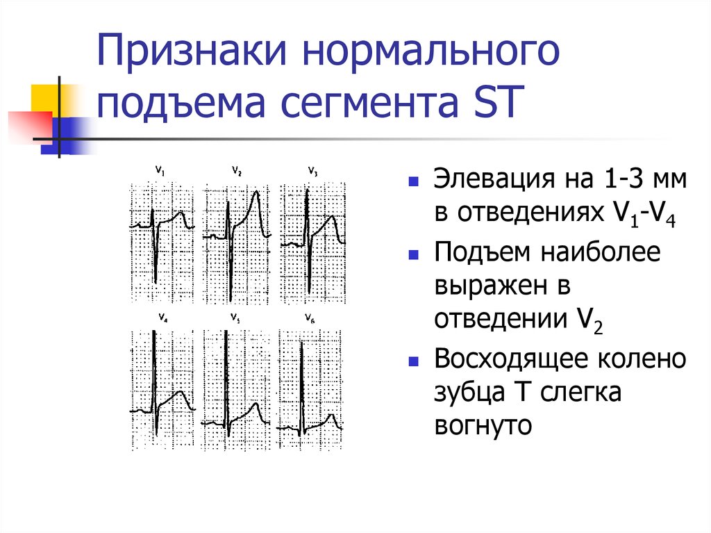 Подъем сегмента. Элевация сегмента St в v1-v6. Элевация сегмента St в v1 v2 v3. Элевация сегмент St в отведениях v2-v4. Элевация St на ЭКГ В 1 отведении.