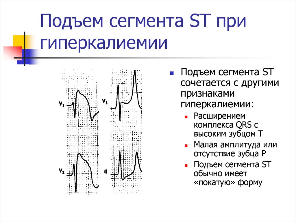 Экг при гиперкалиемии картинки