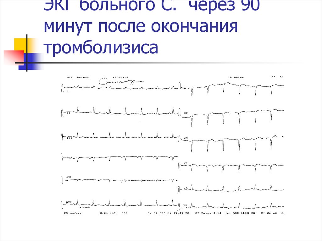 Экг пациентов. ЭКГ после тромболизиса. ЭКГ до тромболизиса и после. Температурный лист ИБС. Температурный лист при ИБС.