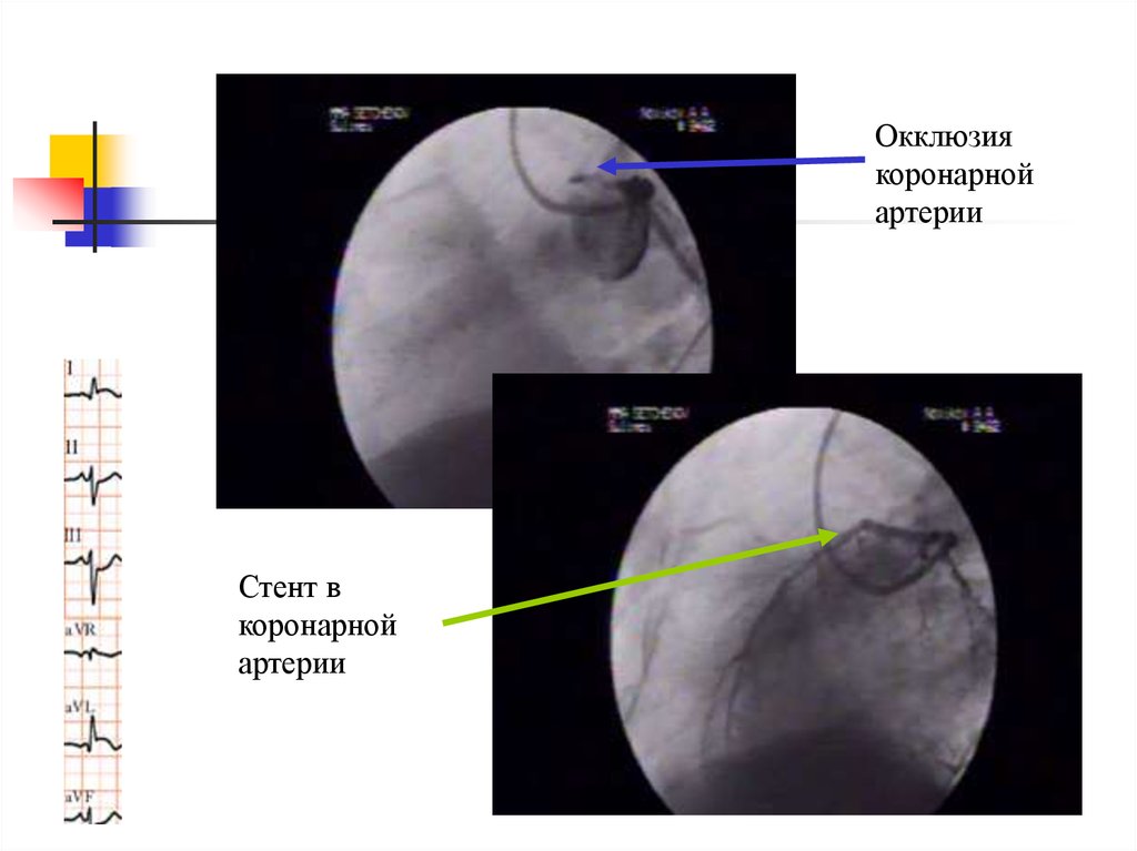 Коронарная окклюзия