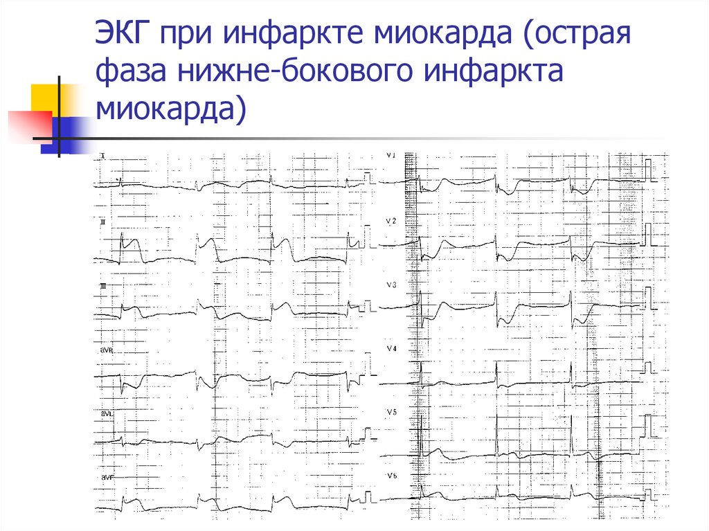 Кардиограмма при микроинфаркте фото как выглядит