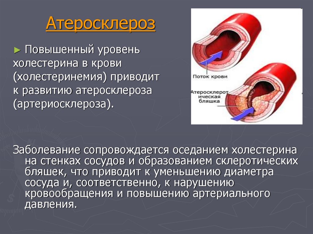 Артерий атеросклероз латынь. Атеросклероз сосудов ишемическая болезнь. Причины заболевания атеросклероза. Атеросклеротические изменения сосудов. Атеросклеротические изменения в артерии.