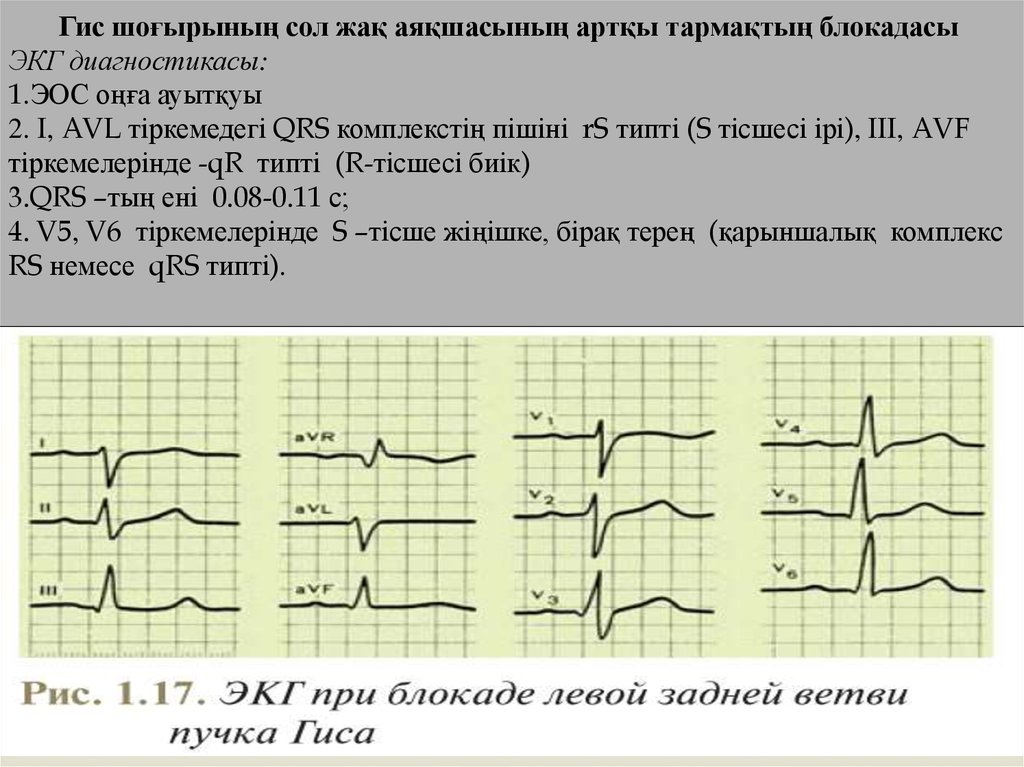 Гис шоғырының сол жақ аяқшасының артқы тармақтың блокадасы ЭКГ диагностикасы: 1.ЭОС оңға ауытқуы 2. I, AVL тіркемедегі QRS