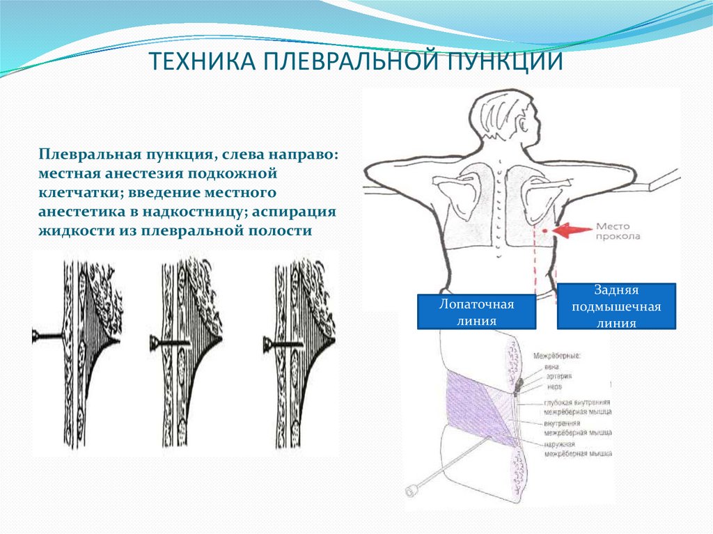 Пункция плевральной полости