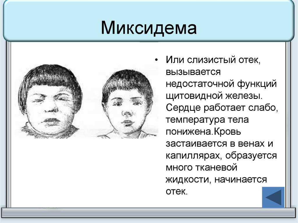 Слизистый отек. Слизистый отек щитовидной железы. Недостаточная функция слизистый отек.