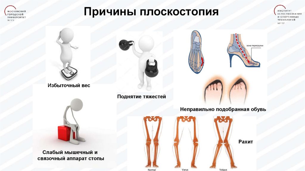 Неправильно подобран. Причины развития плоскостопия. Факторы вызывающие плоскостопие. Причины возникновения плоскостопия. Причины появления плоскостопия.