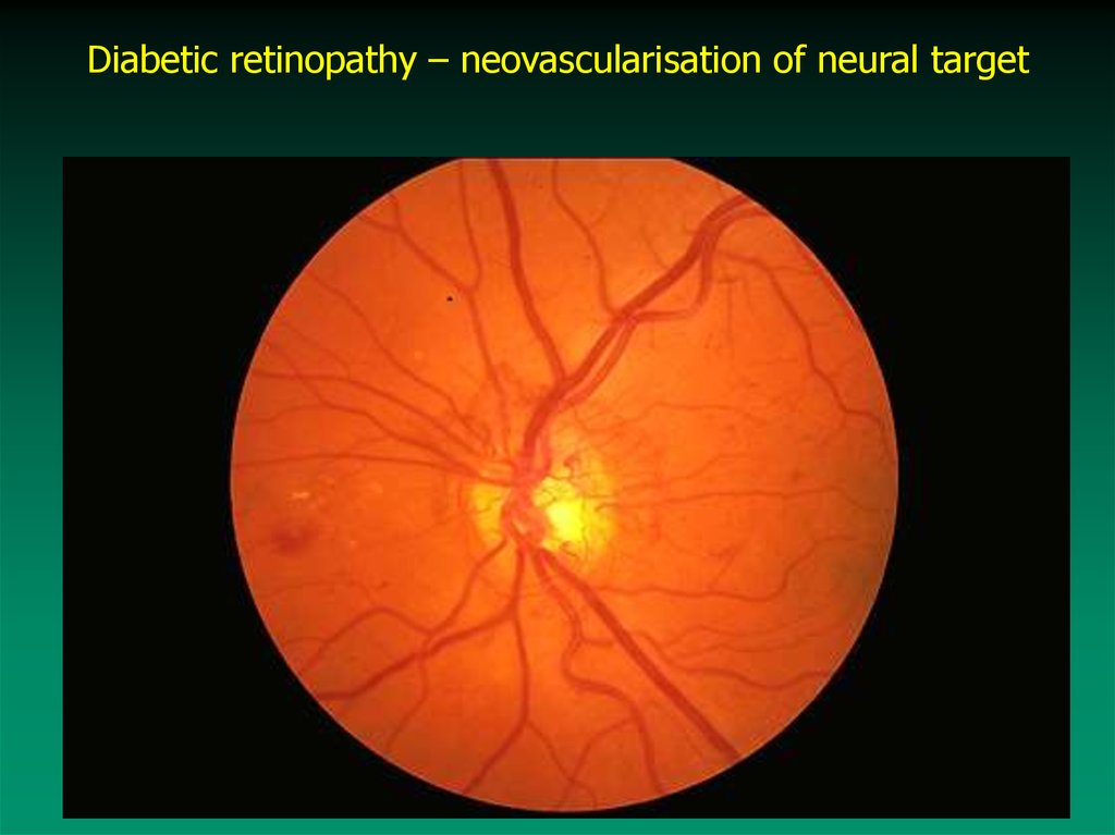 Макулопатия глаза. Диабетическая ретинопатия сетчатки. Пролиферативная диабетическая ретинопатия. Ретинопатия глазное дно. Диабетическая ретинопатия глаз.