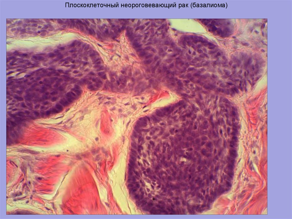 Плоскоклеточная эндометрия. Фиброзирующая базалиома. Базалиома патанатомия. Опухолевидная базалиома.