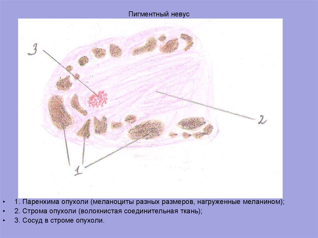 Меланома микропрепарат рисунок