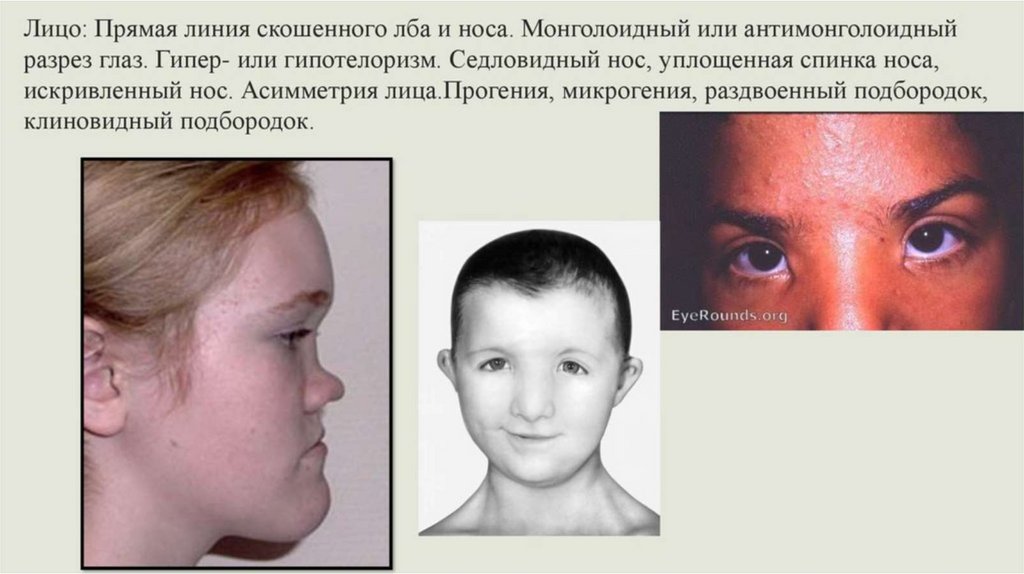 Стигмы дизэмбриогенеза презентация