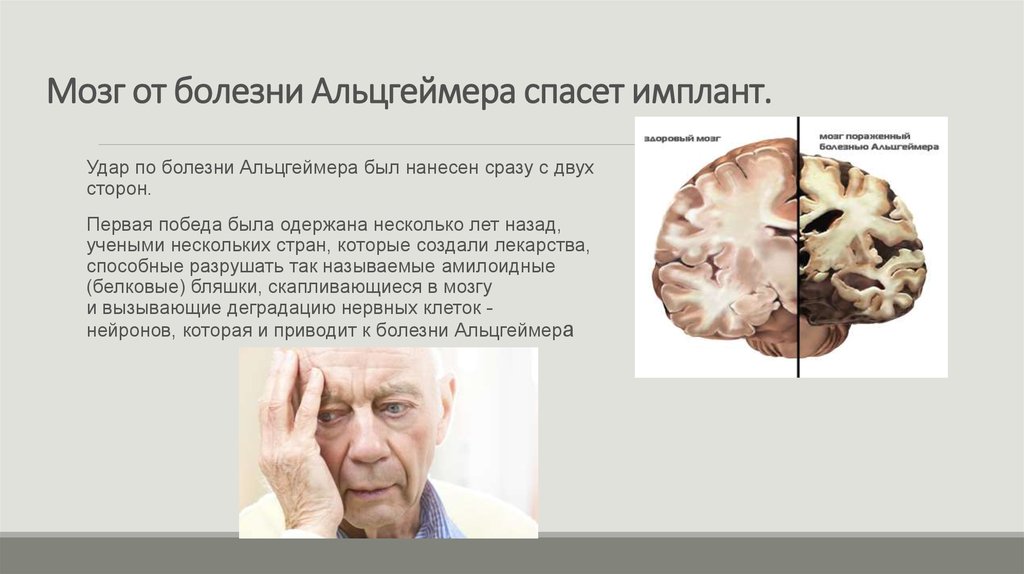 Мозг от болезни Альцгеймера спасет имплант.