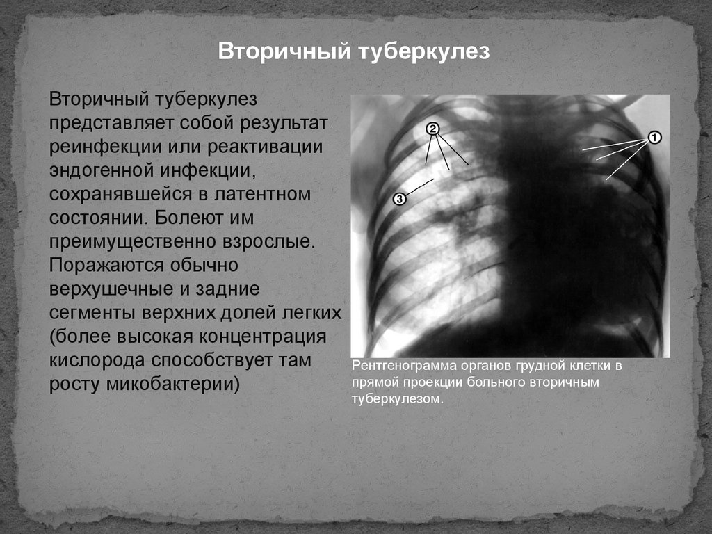 При туберкулезе чаще поражаются. Вторичныи туберкулёза. Вторичный туберкулёз лёгких.