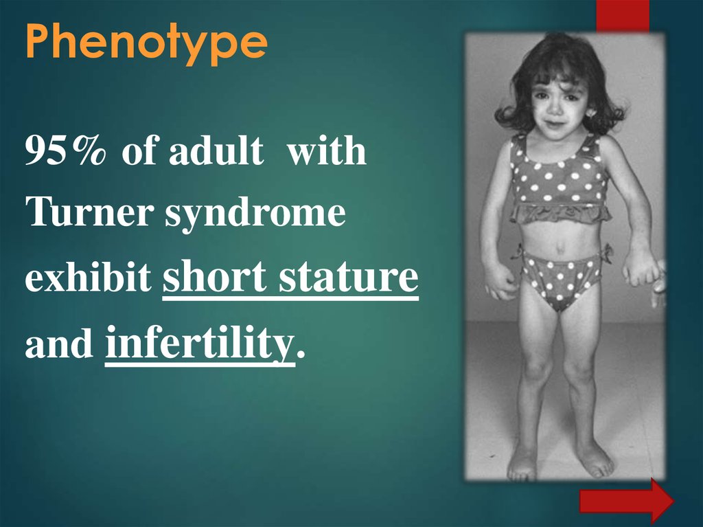 Turner syndrome online presentation