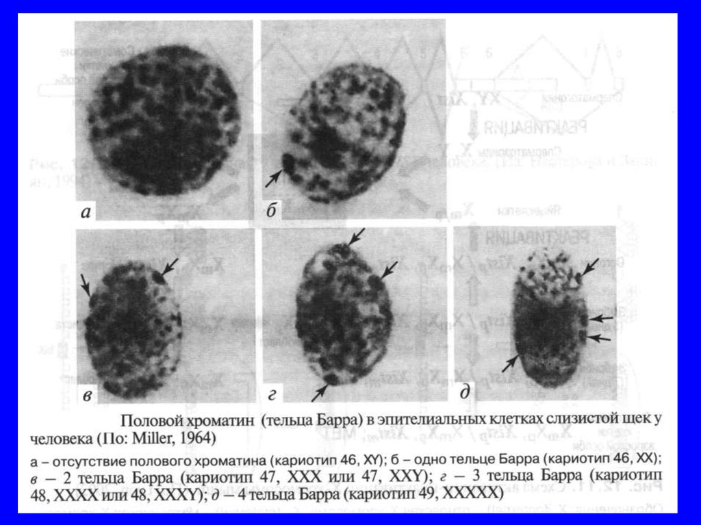 Что такое тельце барра. Тельца Барра под микроскопом. Тельца Барра в микроскопе. Тельце Барра в микроскопе.