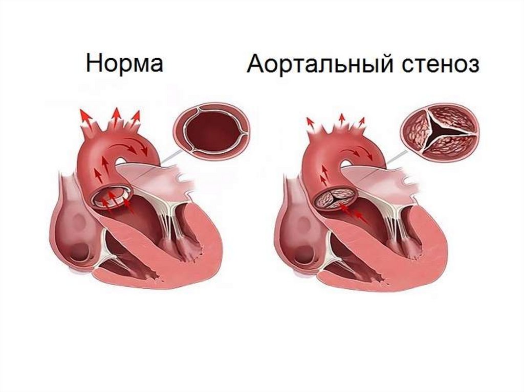 Митральный аортальный стеноз. Кальцифицирующий аортальный стеноз. Критический стеноз устья аорты. Врожденные пороки сердца у детей стеноз устья аорты.