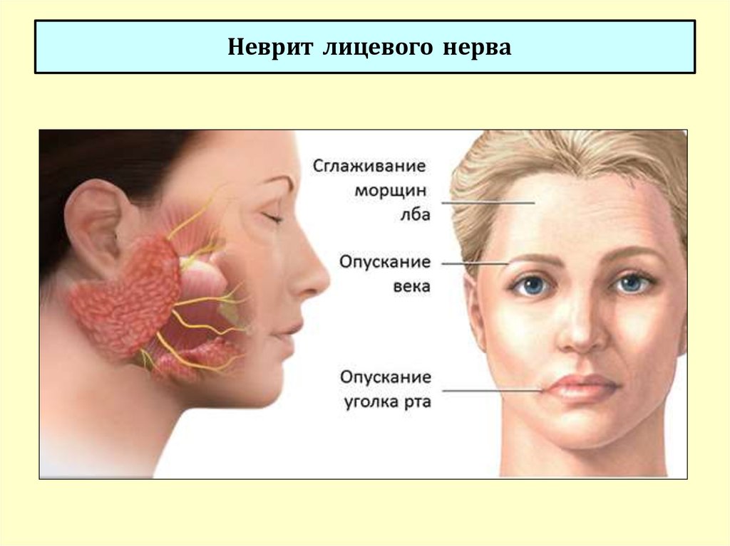 Лечения лицевой невропатия