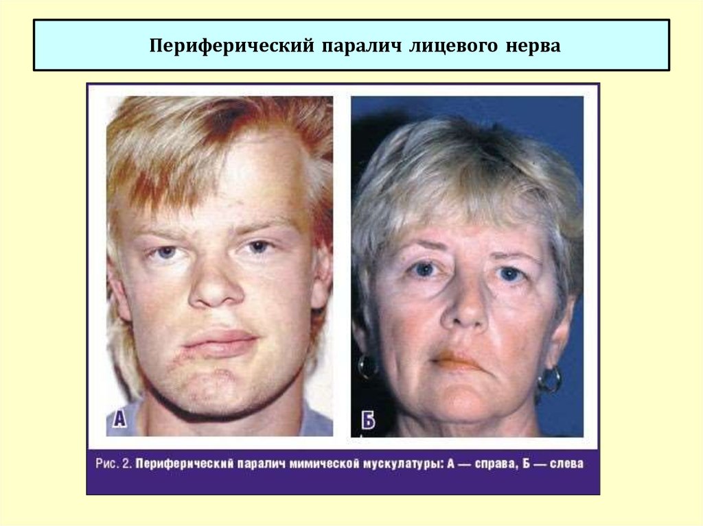 Лицевой нерв справа. Синдром периферического поражения лицевого нерва. Периферичскийпаралич лицеового нерва. Периферический парез мимической мускулатуры. Паралич мимических мышц.