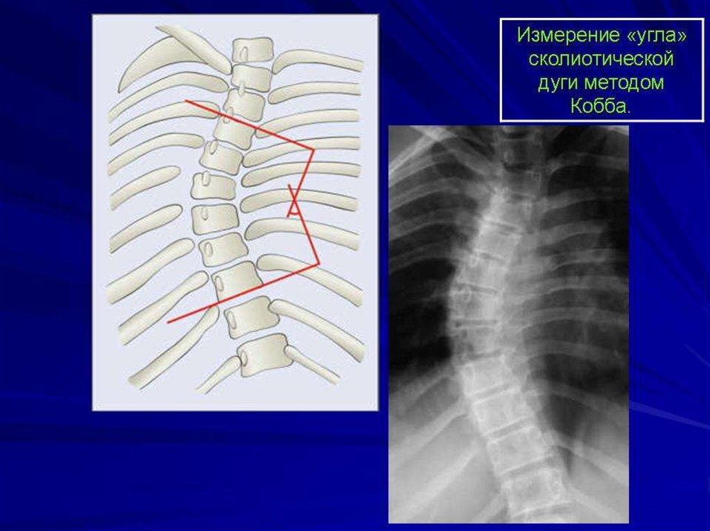Позвоночник метод. Рентген сколиоз угол Кобба. Степени сколиоза по рентгену. Сколиоз по коббу рентген. Кифоз грудного отдела позвоночника рентген.