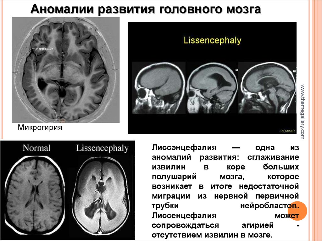 Полимикрогирия