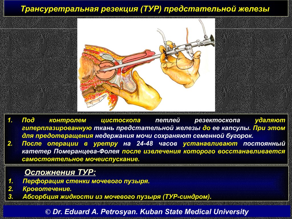 Трансуретральная резекция (ТУР) предстательной железы