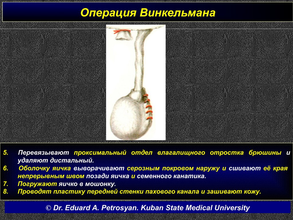 Водянка у мужчин. Гидроцеле яичка операция Винкельмана. Операция Винкельмана Бергмана. Операция Винкельмана при водянке оболочек яичка. Операции Винкельмана Бергмана при гидроцеле.