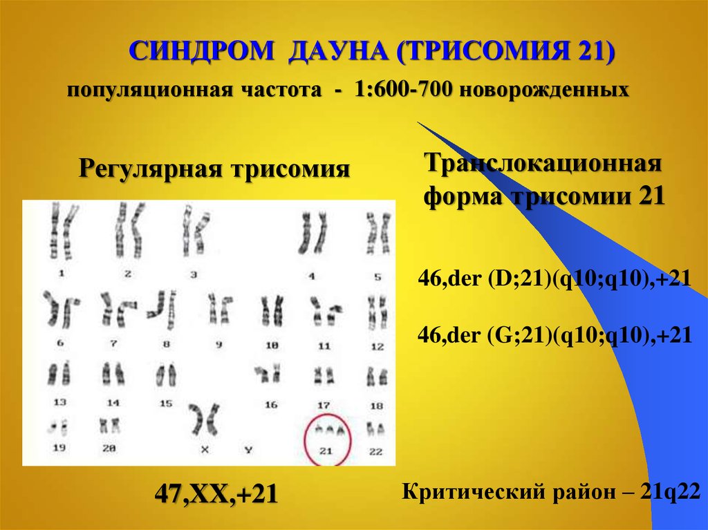 Кариотип дауна. Синдром Дауна транслокационной формы. Трисомия хромосомы 21 транслокационная форма.