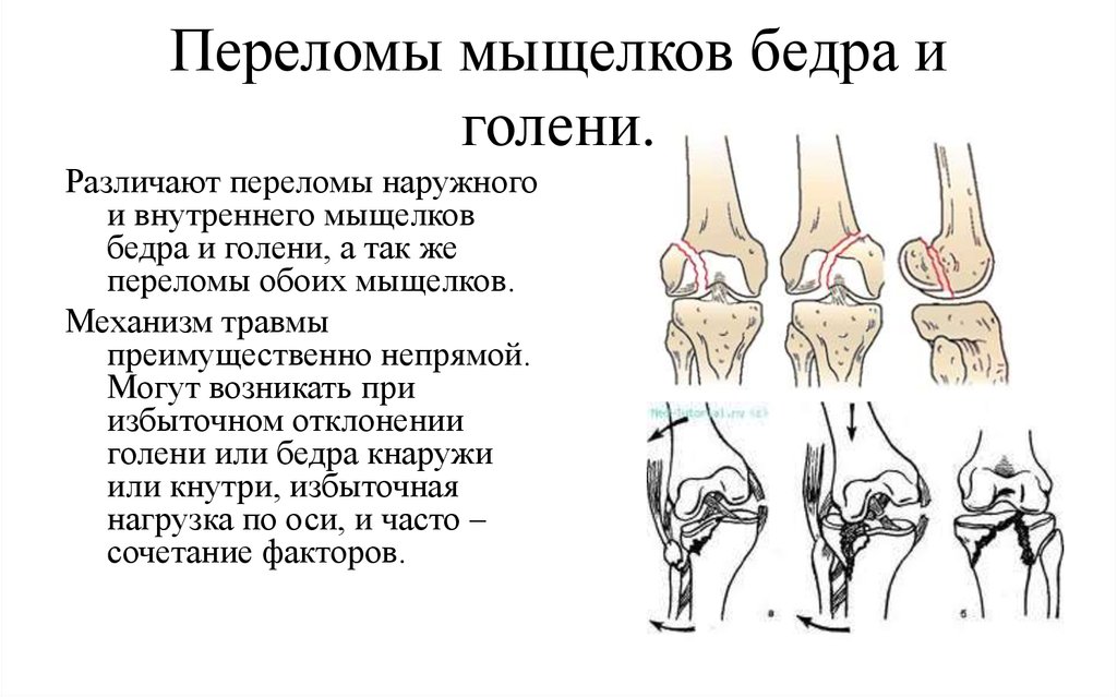 Мыщелок ноги. Закрытый перелом наружного мыщелка большеберцовой. Перелом задних отделов латерального мыщелка большеберцовой кости. Перелом латеральной мыщелки бедренной кости. Перелом внутреннего мыщелка бедра.