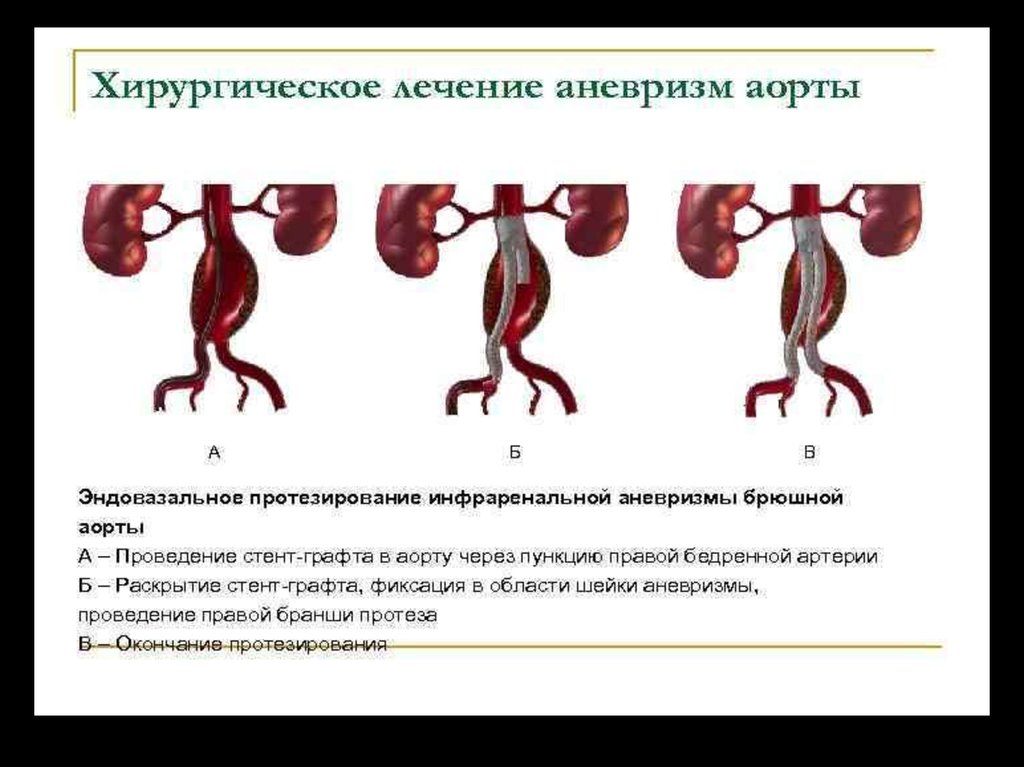 Аневризма брюшной аорты карта вызова