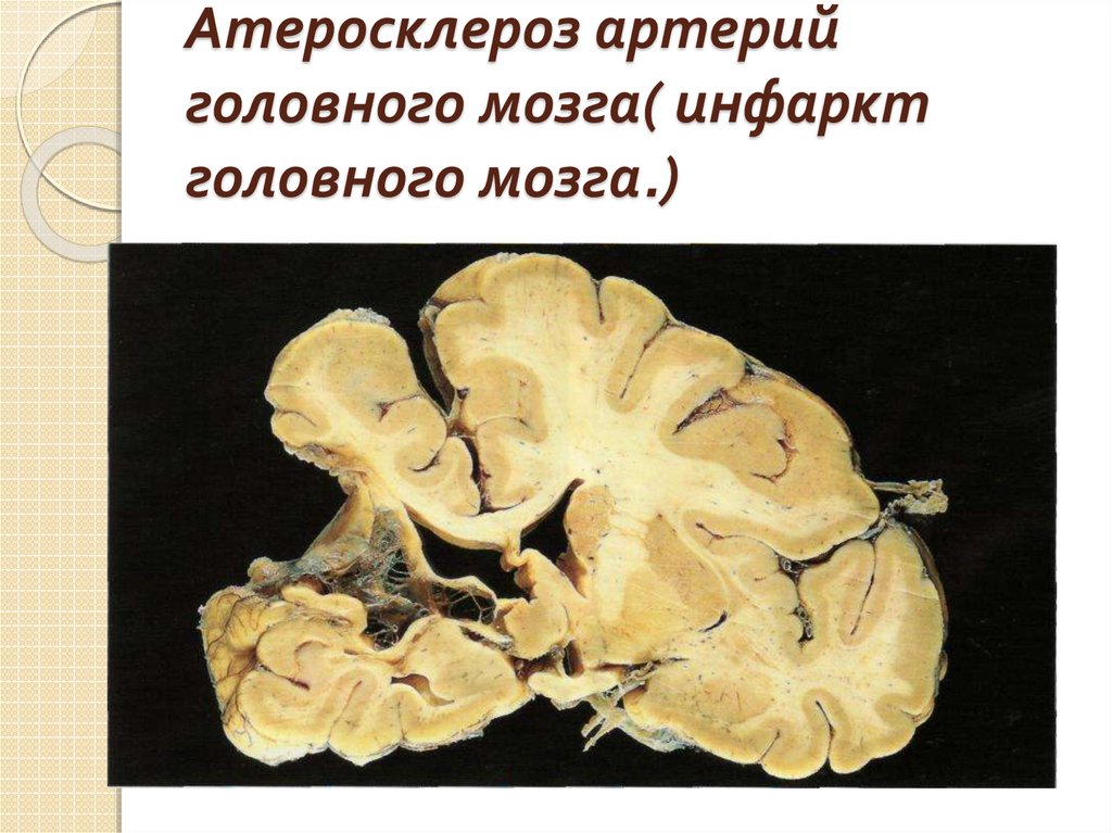 Лечение церебрального атеросклероза головного мозга. Атеросклероз артерий головного мозга. Церебральный атеросклероз сосудов головного мозга. Атеросклероз церебральных артерий. Атеросклероз церебральных сосудов осложнения.