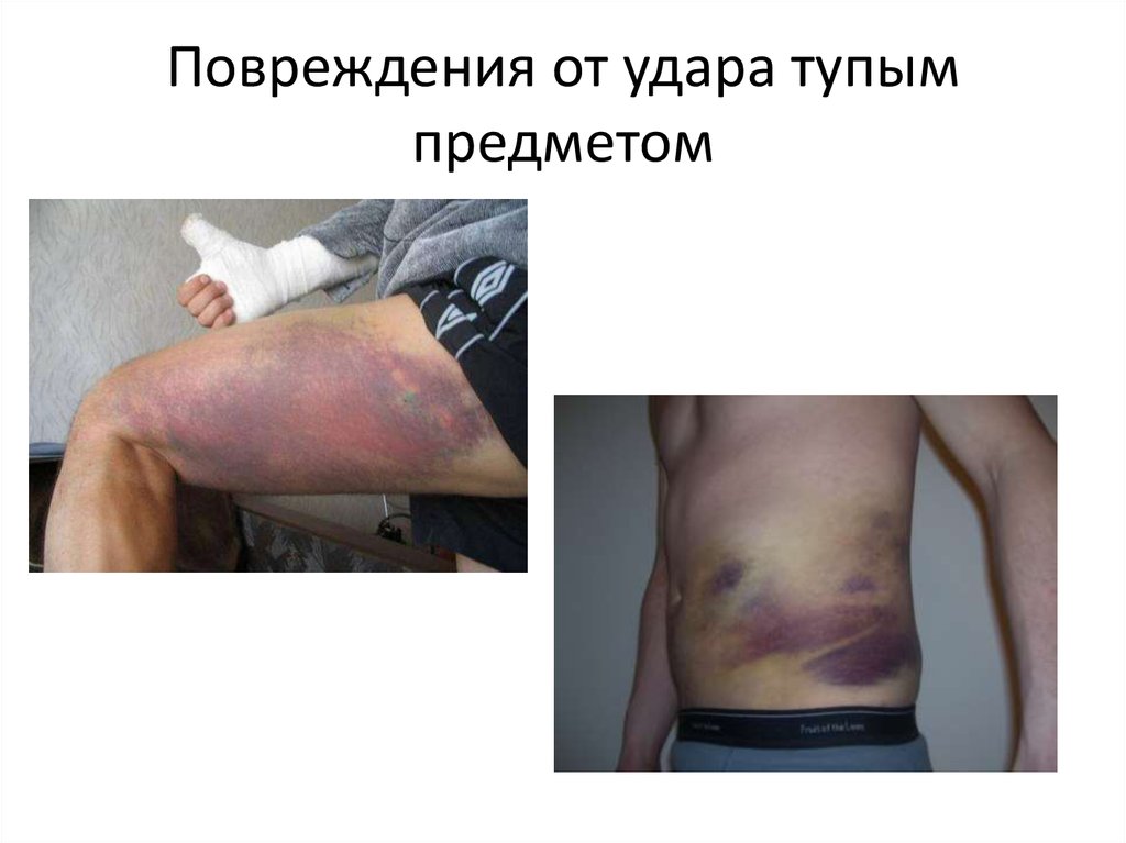 Повреждения от удара тупым предметом