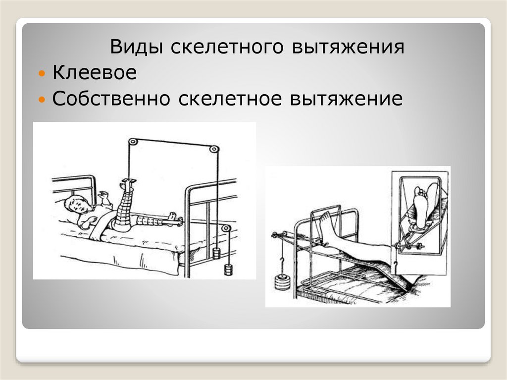 Скелетное вытяжение. Показания к применению скелетного вытяжения. Скелетное вытяжение показания техника. Клеевое скелетное вытяжение. Метод постоянного скелетного вытяжения. Манжетное, клеевое.