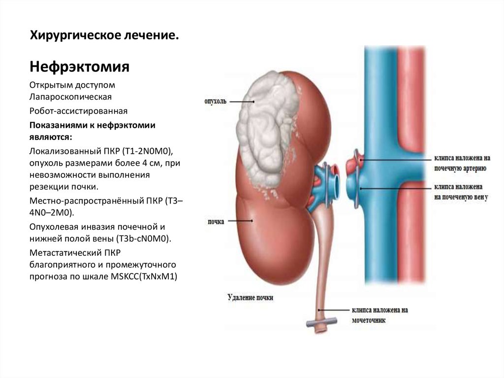 Резекция почки что это. Нефрэктомия Оперативная хирургия. Резекция опухоли почки. Радикальная нефрэктомия этапы. Нефрэктомия схема операции.